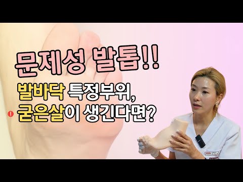 발바닥 굳은살이 생기는 이유와 내성발톱 예방 방법을 알아보자!