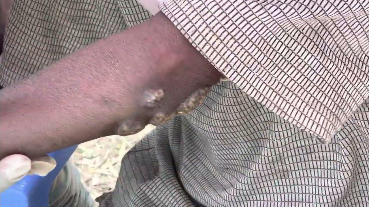 WRONG jigger treatments damaged Wafula's feet subscribe to see full vids YouTube