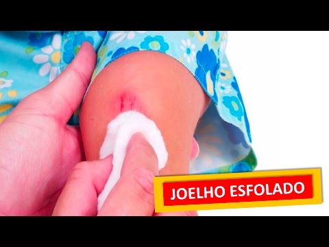 Vídeo: Joelho Raspado: Tratamento E Infecção