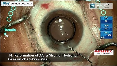 Precizon Presbyopic implantation by Dr. Junhun Lee, Korea