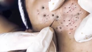 얼굴에 여드름 &amp; 화이트 헤드를 쉽게 제거하는 방법 | 어떻게 밤새 여드름을 제거하려면!? #14