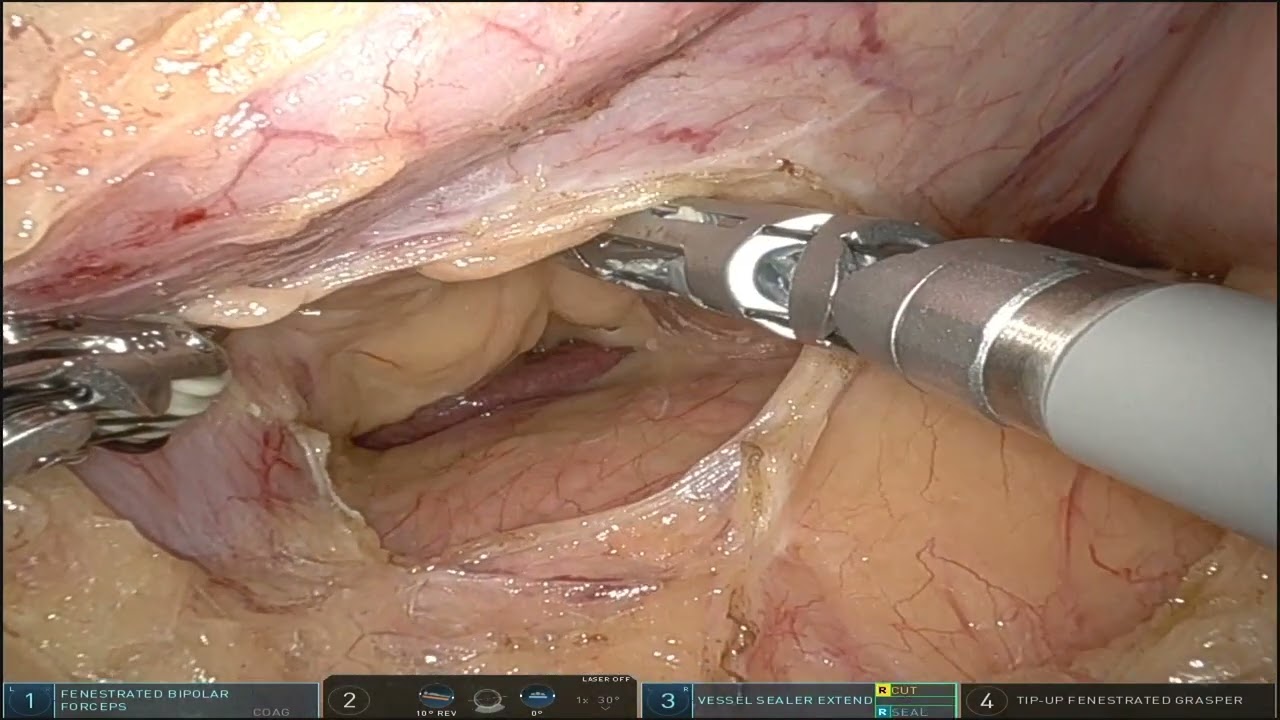 Duodenum Dissection (Separation) on a 98 BMI Patient