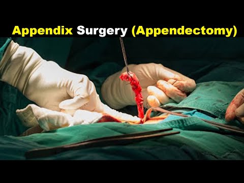 How Does Appendectomy Works | Appendicitis Treatment