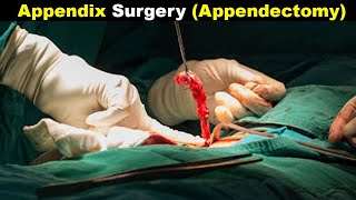 How Does Appendectomy Works? | Appendicitis treatment (Urdu/Hindi)