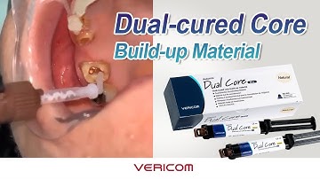 Dual Core Advantages, Tutorial(Post Cementation & Core Build-Up)