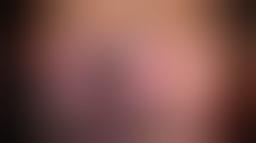 Flanged Intrascleral Intraocular Lens Fixation for Subluxed lens in Marfan