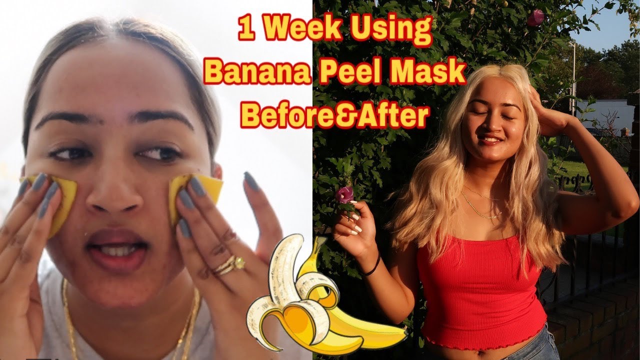 Featured image of post Will Banana Peel Help Acne Scars : You can have only one deep peel.