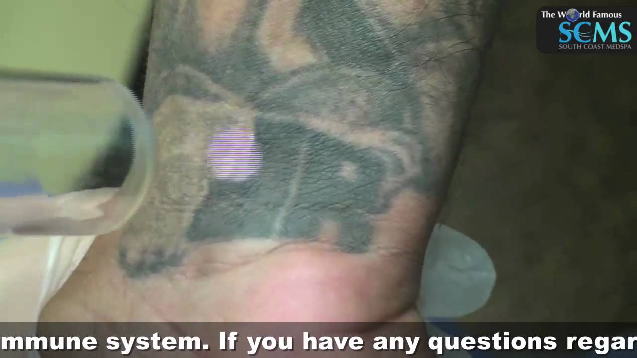 Laser Tattoo Removal Wrist YouTube