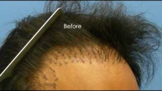 Hair Transplant Repair - 3170 hair transplant Grafts