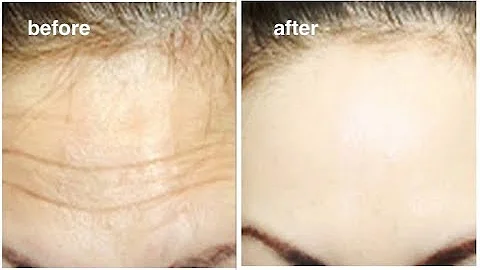 1 Smart trick to Rapidly Remove Wrinkles & Fine lines on Forehead In 2 Days - DayDayNews