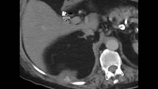 Dropped Gallstones with Abscess