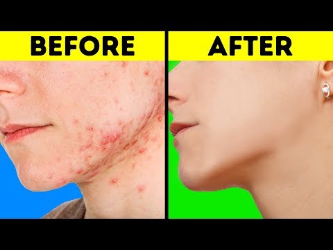  EASY LIFE HACKS FOR DULL AND ACNE SKIN
