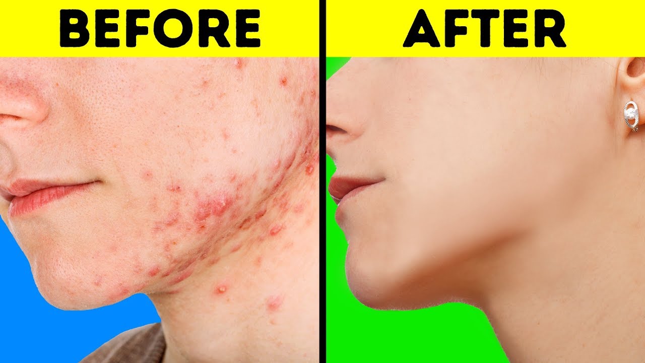 33 EASY LIFE HACKS FOR DULL AND ACNE SKIN