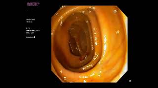 MultiCROC® Random Biopsy of the Colon
