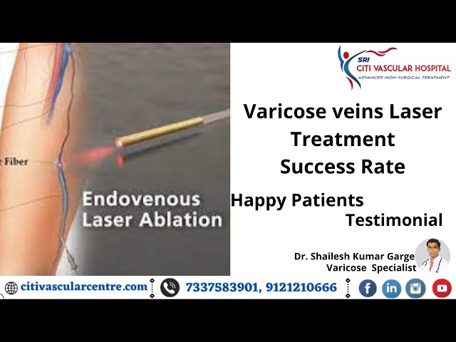 Varicose Veins Laser Treatment Cost In India