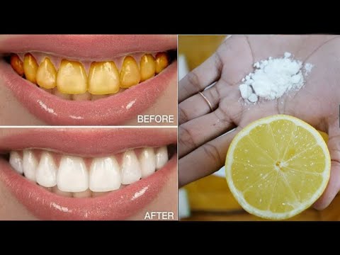 Magical Teeth Whitening Remedy, Get whiten Teeth at home in 5 minutes | teeth whitening in Telugu