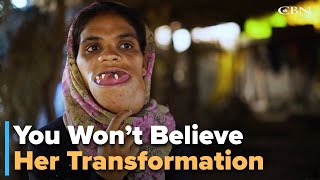 Operation Blessing’s Life-Changing Surgery: Durga’s Incredible Transformation