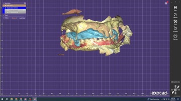 Exocad - Align Upper Jaw & Lower Jaw with Bite Scan