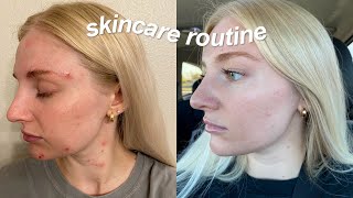 my skincare routine (skin cycling, Morpheus8 treatment, chemical peel)