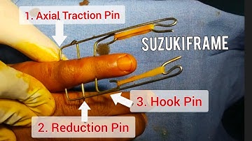 Suzuki Frame Chirurgie | Subluxatie van een vinger PIP-gewrichtsfractuur | Dr. Prateek Joshi