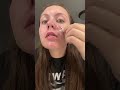 i’m so tired #pimplepatchremoval #satisfying #asmr #pimple #pimplepatches #acne #pimpleproblem