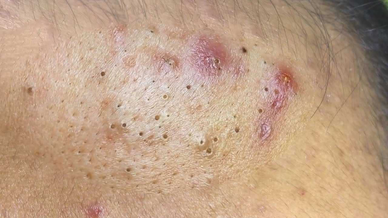 Suri Job #629: Great Get Rid Of Blackheads On Forehead