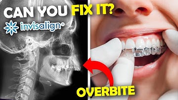 Kan Invisalign een overbeet verhelpen?... Orthodontist legt uit