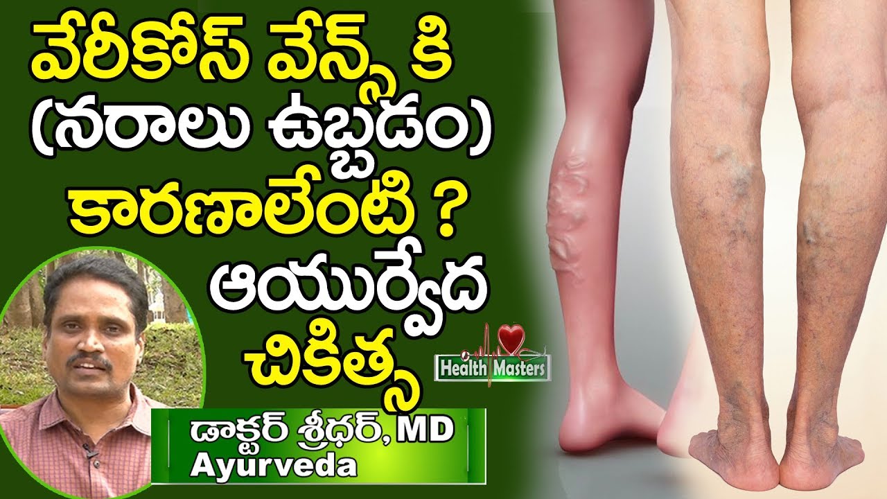 Varicose Veins Treatment in Ayurveda by Dr Sridhar Amrutha Aaharam