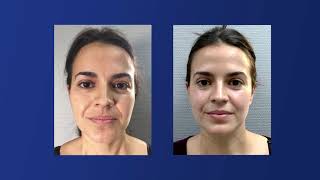 Peeling Zo 3 Step Peel de ZO SKIN HEALTH - Dr. Zein Obagi