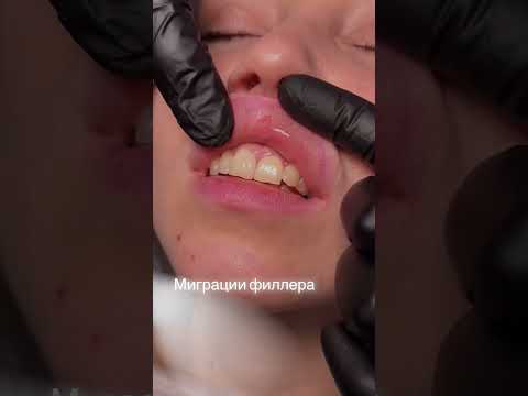 Видео: Как избавиться от мигрировавшего филлера в губы?