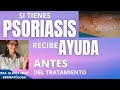  stop psoriasis sencillos consejos  que te ayudarn dermatloga gloria abad