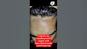 regrow receding hairline after 15 month use of minoxidil Finasteride #shorts