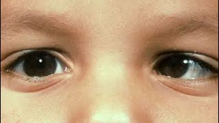 حول الأطفال | متى أراجع طبيب عيون