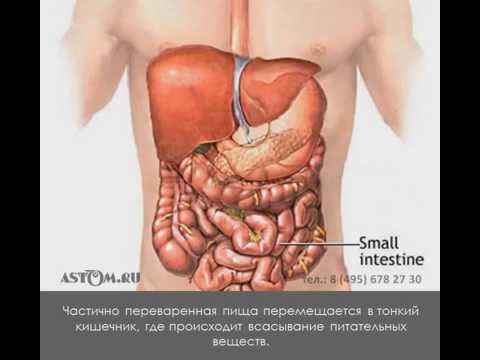 Виды стом. Что такое колостома, илеостома, уростома.