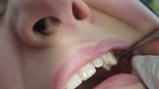 20 Lik Çekim Kolay Mı. Üst Çene