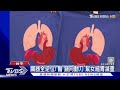 臟器全逆位! 醫「鏡向動刀」幫女縮胃減重｜TVBS新聞 @TVBSNEWS02