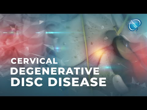 Video: Vad är discovertebral degeneration?