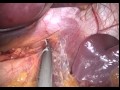 Laparoscopic Sleeve Gastrectomy عملية تكميم المعدة