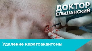 Удаление кератоакантомы