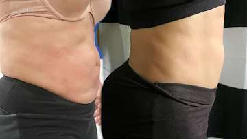 ¿Vuelve a aparecer grasa después de CoolSculpting?