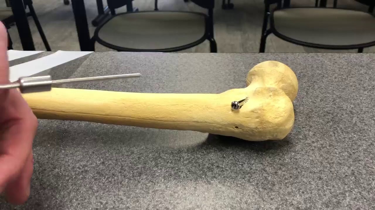 SCFE screw removal Saw Bones YouTube