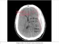 Intracranial Bleed - Part 4