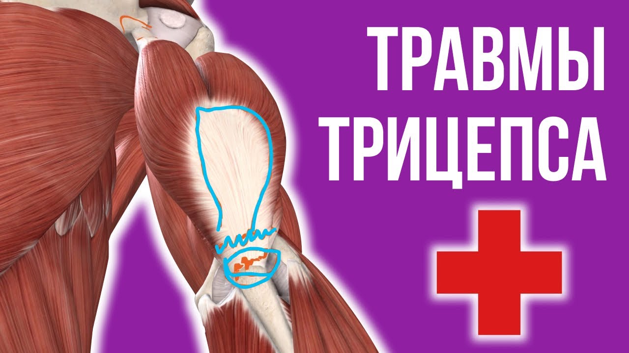 ПОВРЕЖДЕНИЕ ТРИЦЕПСА - разрыв, отрыв, растяжение, операции, лечение ...