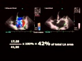 Echocardiographic Assesment of Mitral Regurgitation