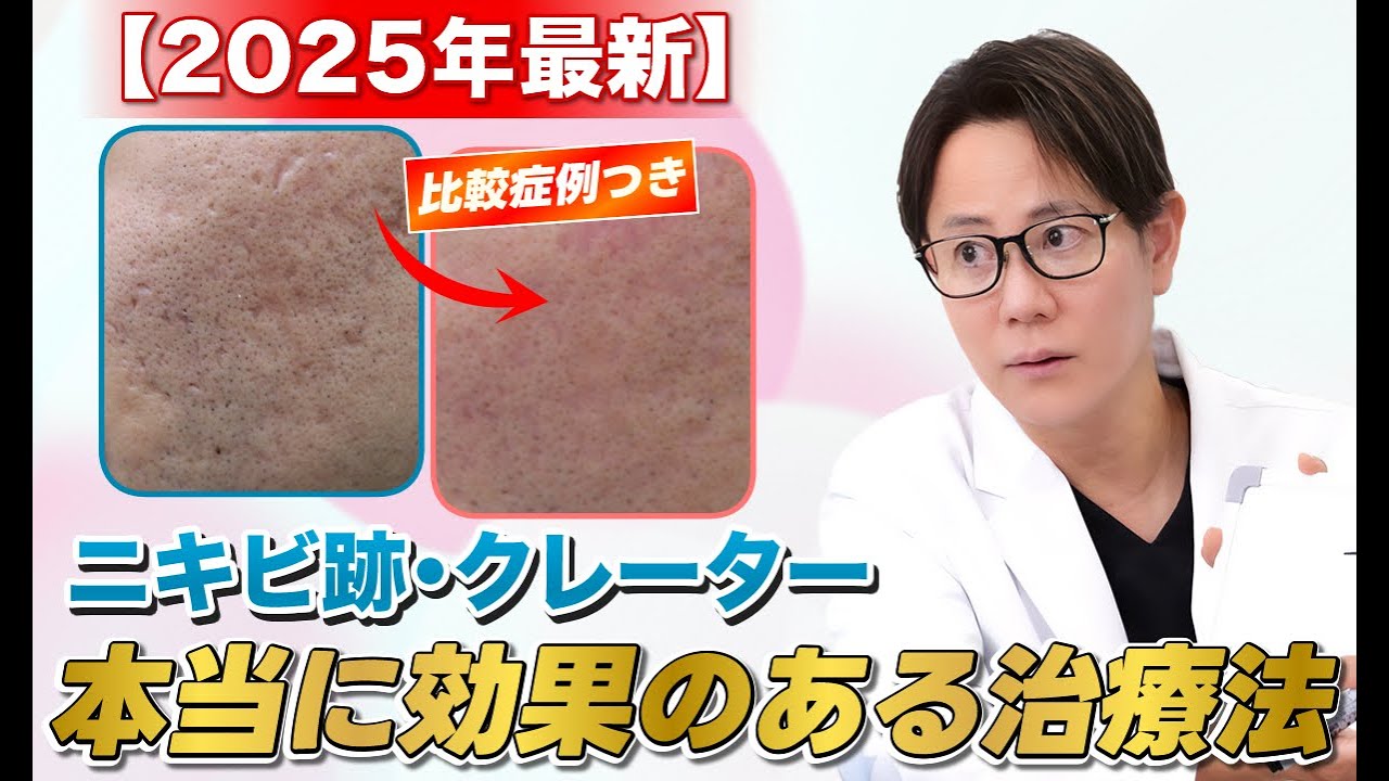 【2025年最新】ニキビ跡｜これを見れば本当に効果のあるクレーター最新治療が分かります！
