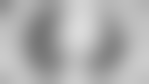 VATS lingular (S4 + S5) segmentectomy for pulmonary metastasis