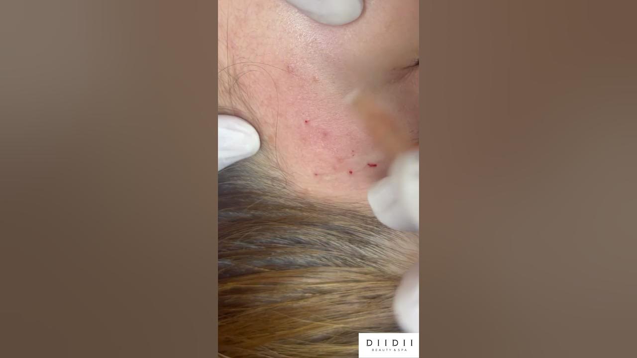Pimple Extraction Shocking Results You Won't Believe! YouTube Pimple Extraction Shocking Results You Won't Believe! YouTube