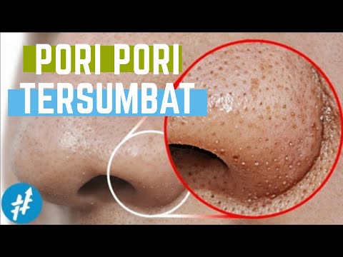 Video: Pori-pori Hidung Yang Membesar: Cara Membuka, Membersihkan, Dan Mengecilkannya