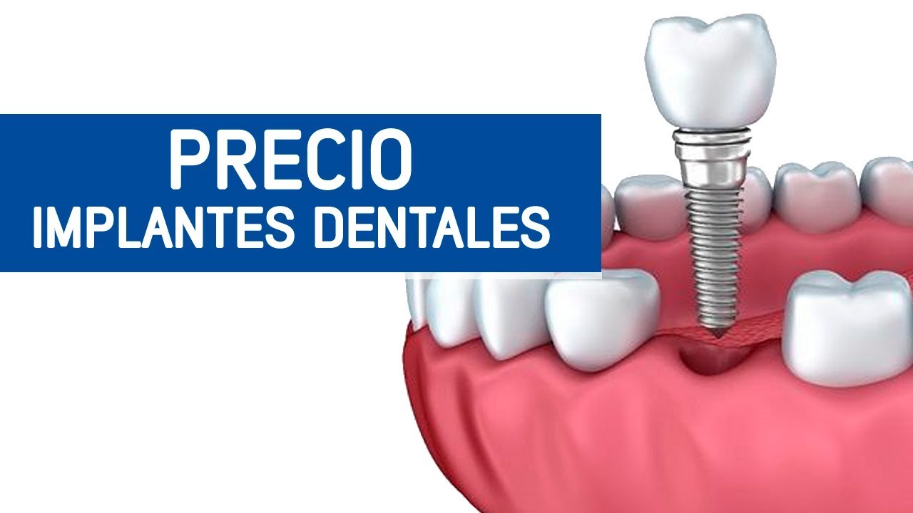 Profeta Ir a caminar Elasticidad Implantes dentales precio/ Odontoespecialistas - YouTube