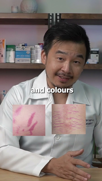 FINALLY: A Cure For Stretch Marks